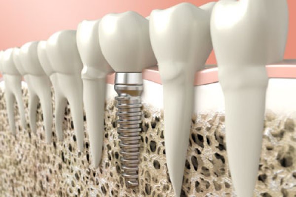 Dental Implants: When Is A Bone Graft Necessary?
