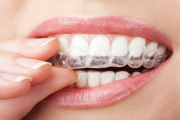 Why You Will Love Clear Aligners For Straightening Teeth