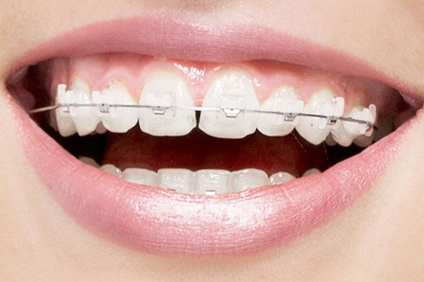 Why Clear Braces Are A Popular Option For Teeth Straightening