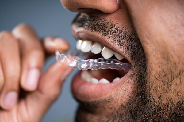 A Cosmetic Dentist Explains Benefits of Clear Aligners from Garden Dental Arts in Brooklyn, NY