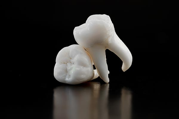 A General Dentist Talks Tooth Extractions from Garden Dental Arts in Brooklyn, NY
