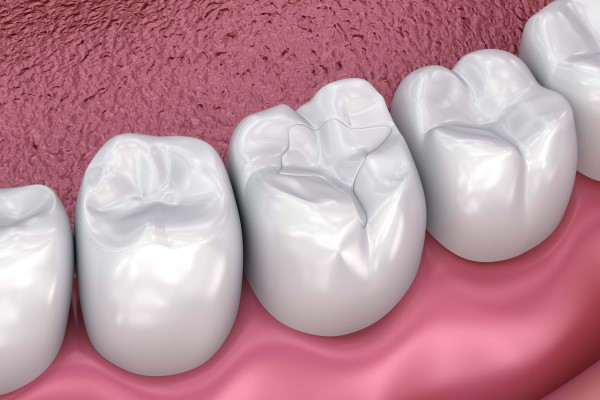 Why A Family Dentist Recommends Dental Sealants For Adults